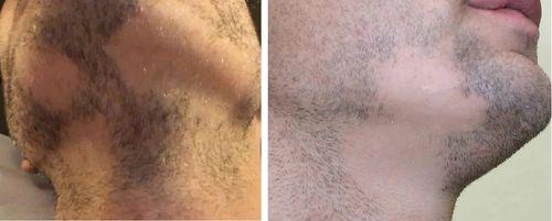 Alopecia Patients show early stages of patchy beard